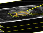 Usformer - A small network for left atrium segmentation